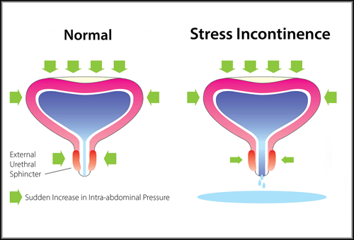 Stress Urinary Incontinence